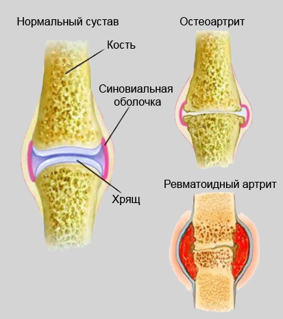 Ревматоидный артрит ног
